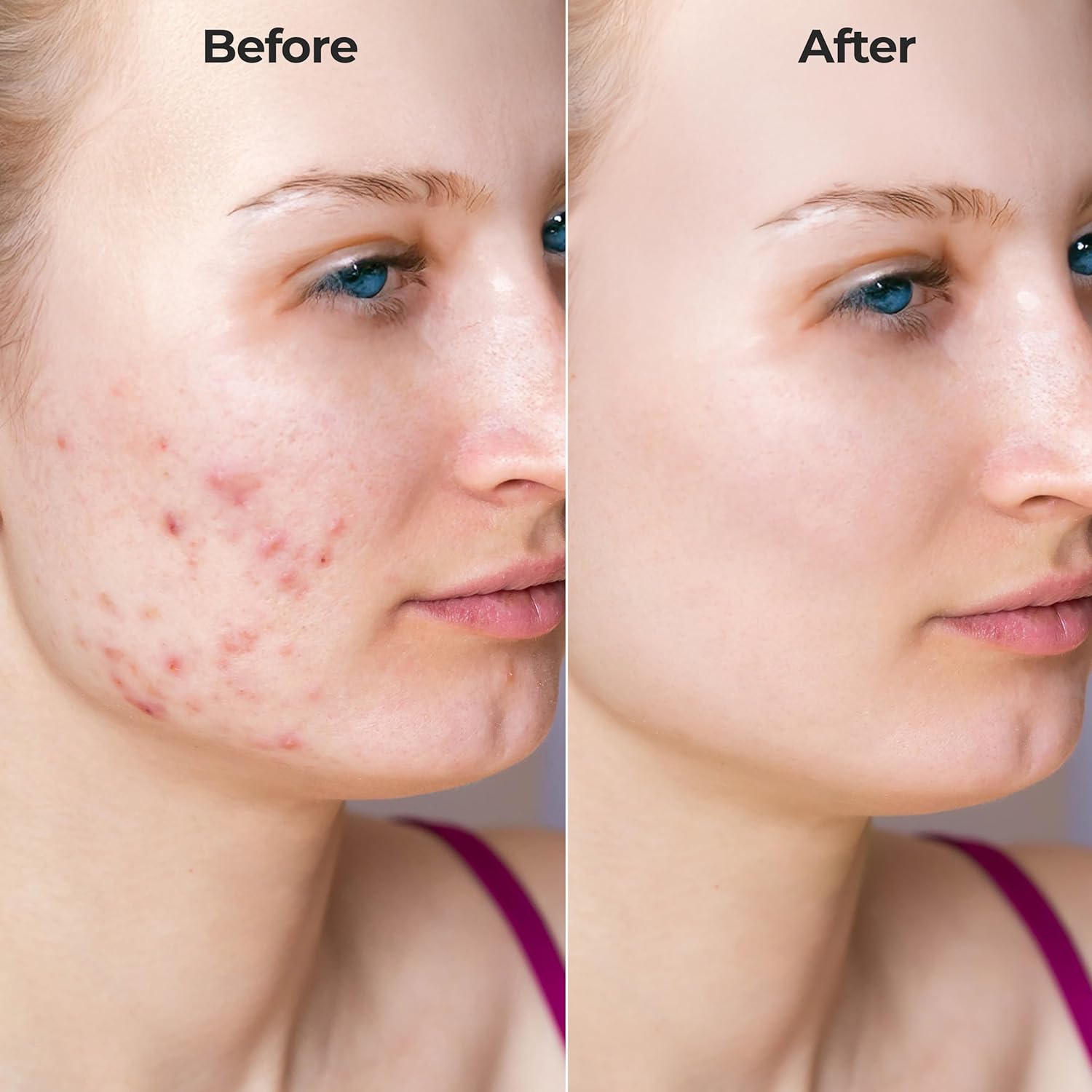 FLexiknee Microrevive Titanium Micro Infusion System for Face - Deep Penetrating, Collagen-Boosting Stamp & Anti-Wrinkle Hyaluronic Acid Serum - At Home Micro Needling Kit for Radiant, Youthful Skin